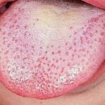 Pengobatan Candidiasis: Tips dan Cara Efektif Mengatasi Infeksi Jamur