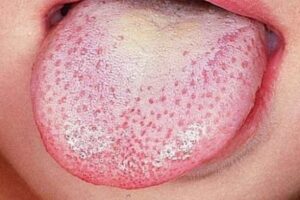 Pengobatan Candidiasis: Tips dan Cara Efektif Mengatasi Infeksi Jamur